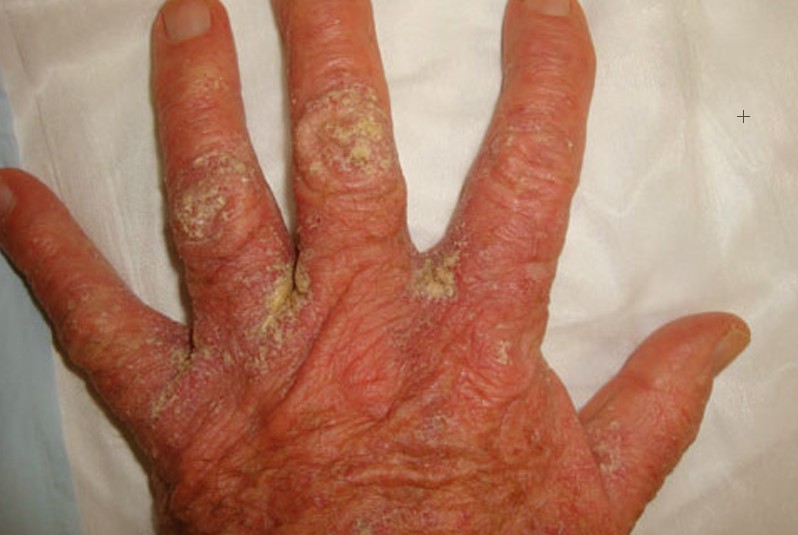 crusted scabies on hand