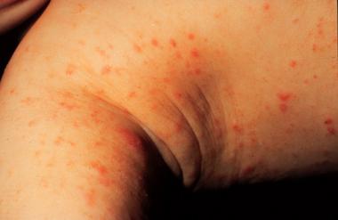 scabies on child armpit