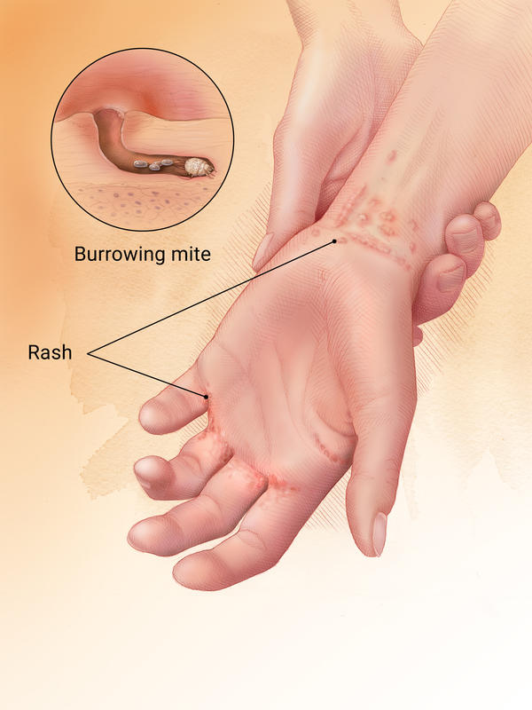 Illustration of Scabies Mite and Burrow